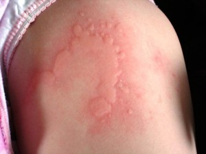 Borrelia-fertőzés (Lyme-kór) - Dr. Balaicza Erika